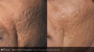 Treat Your Acne Scars With Our PicoSure Laser - The Aesthetic Laser ...