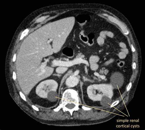 Renal pathology - Radiology Cafe