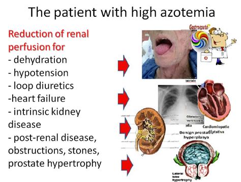 Azotemia: Types, Causes, Symptoms Treatment, 54% OFF