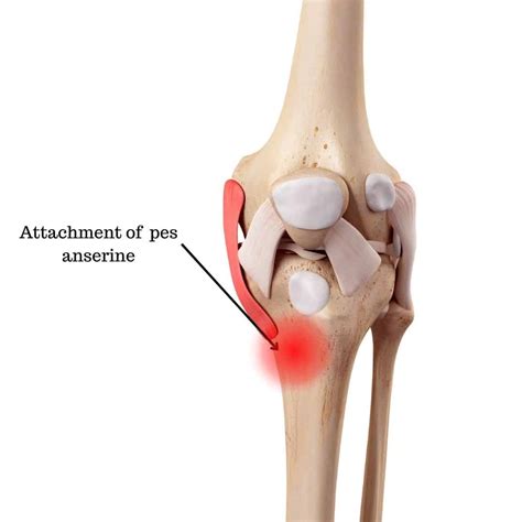 Pes Anserine Bursitis: Causes, Symptoms Treatment Guide, 53% OFF