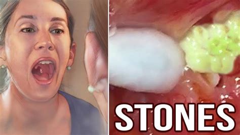 Removing Tonsil Stones At Home ( Compilation ) - YouTube