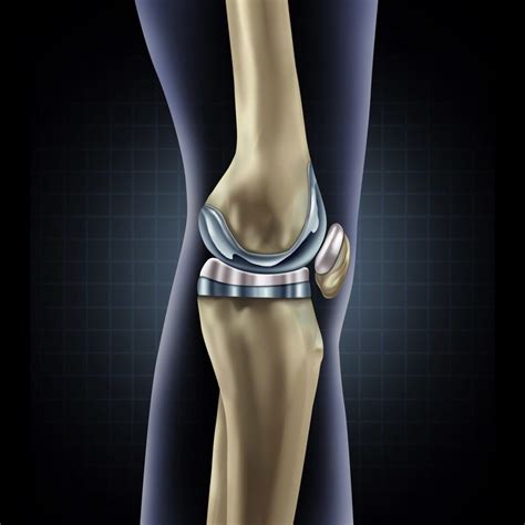 Knee Replacement - Space Coast OrthopedicMerritt Orthopedics - Merritt ...