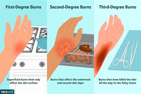 First Aid for Burns: 1st, 2nd, and 3rd Degree