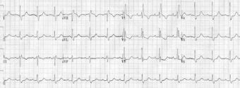 Right Bundle Branch Block (RBBB) • LITFL • ECG Library Diagnosis