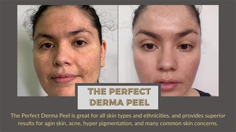 The Perfect Derma Peel (Before and After) at Brow Down Studio, Los Angeles - YouTube