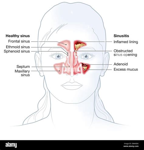 Illustration showing healthy sinus and sinusitis with inflamed lining, obstructed sinus opening ...