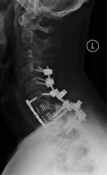 Lateral radiograph of the cervical spine after posterior C4-T1 fusion ...