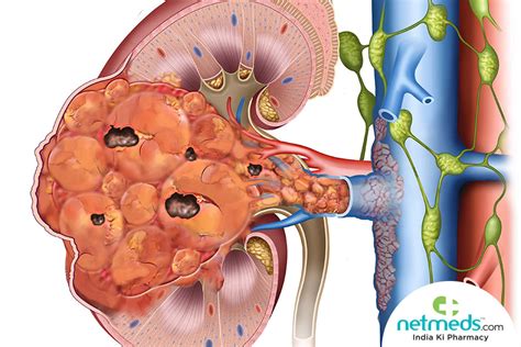 Wilm’s Tumor: Causes, Symptoms and Treatment