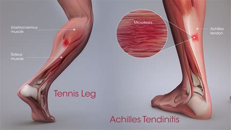 Leg Tendon : Right Side Leg Pain Causes Symptoms Treatment Ending Lines