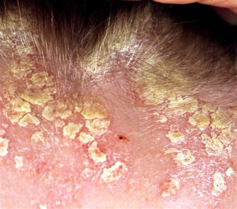 Scalp Psoriasis - Causes, Symptoms, Treatment, Pictures, Remedies ...