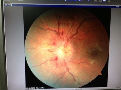 Optic Nerve Disease - Eye Specialist, Treatments, Types and Symptoms | Nerve diseases, Pediatric ...