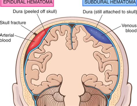 Lucid interval definition and causes