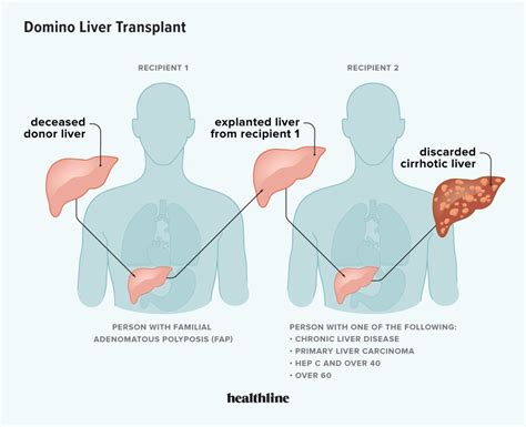 Domino Liver Transplant: Benefits, Procedure, Outlook, and More