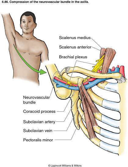 Thoracic Outlet Syndrome (TOS) - Physiopedia