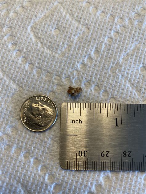 1 Year later and it’s finally out. 7mm stone : r/KidneyStones