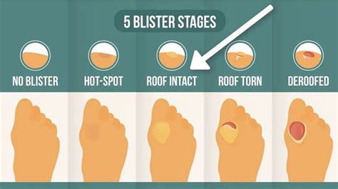 How To Get Rid Of A Foot Blister - Numberimprovement23