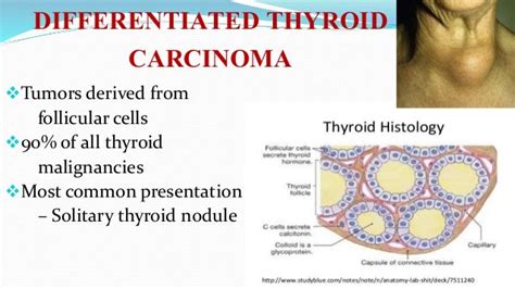 Thyroid Carcinoma Types