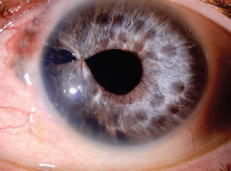 CRSToday | Traumatic Cataract With an Irregular Pupil