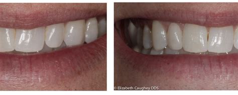 Feldspathic Veneer | Peg Lateral - Elizabeth Caughey DDSElizabeth ...