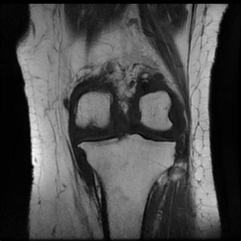 Pes anserine bursitis | Image | Radiopaedia.org