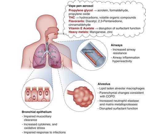 Vaping-Related Acute Parenchymal Lung Injury - CHEST