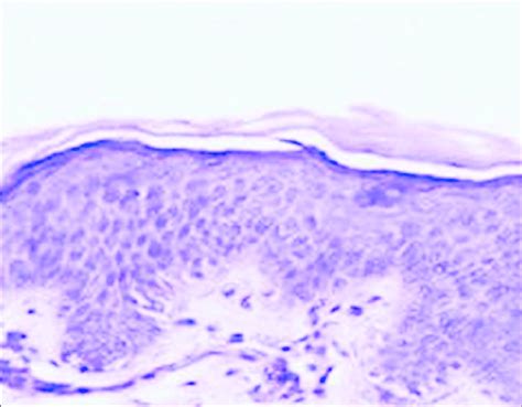 Separation of stratum corneum from stratum granulosum with sparse ...