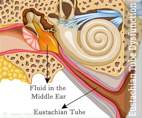 Eustachian Tube Dysfunction - Causes, Symptoms, Diagnosis, Treatment