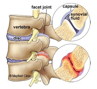 Facet Joint Syndrome and Pain - Peak Form Health Center