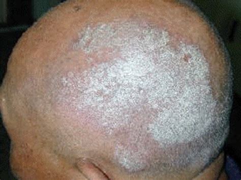 Scalp Psoriasis - Causes, Symptoms, Treatment, Pictures, Remedies ...