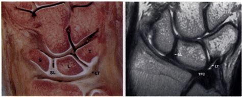 Lunotriquetral dissociation - Physiopedia