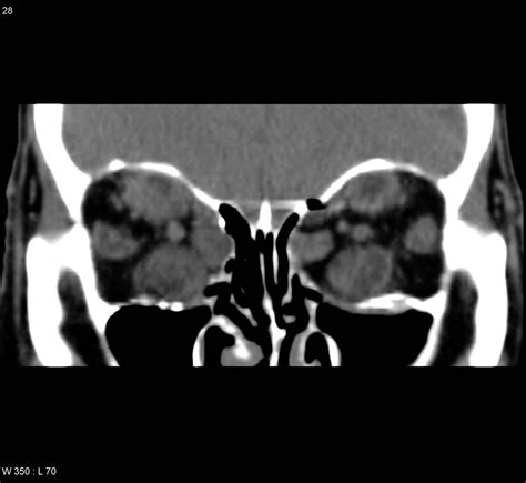 Optic nerve glioma differential diagnosis - wikidoc