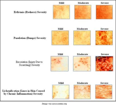 Eczema: Causes, Symptoms, and Treatments to Reduce Eczema