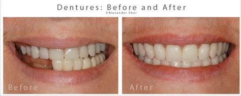 Dentures Before & After Seattle - Shor Dental