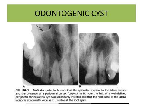 PPT - CYSTS&CYSTLIKE LESIONS OF THE JAWS PowerPoint Presentation - ID:6003647