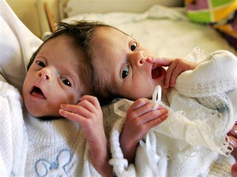 Conjoined twins (WARNING: GRAPHIC IMAGES) | Conjoined twins, Twins, Human oddities