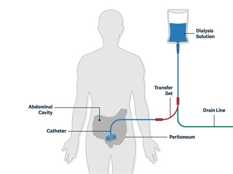 Kidney care options peritoneal dialysis | U.S. Renal Care