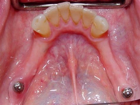 Implant Dentures (Partial) - Northland Prosthodontics - Northland Denture Specialist - Whangarei