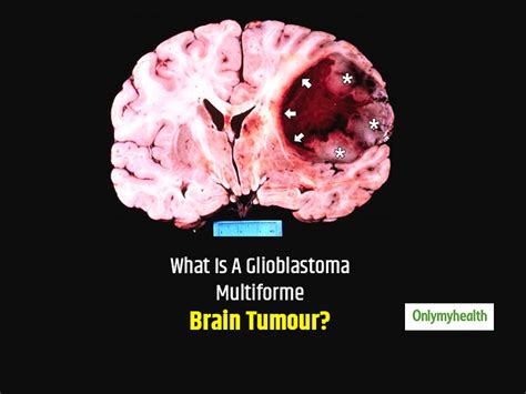 World Brain Day 2020: Causes, Symptoms And Treatment Of Glioblastoma ...