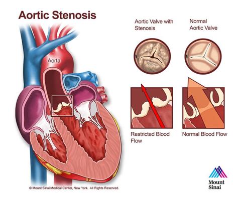 Aortic Stenosis - The Mount Sinai Hospital | Aortic stenosis, Pediatric ...