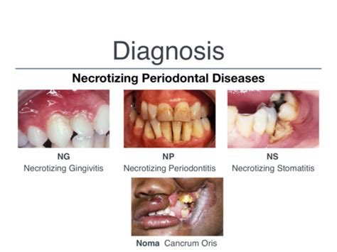 5. Necrotizing Periodontal Disease Flashcards | Quizlet