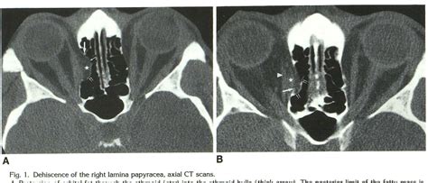 [PDF] Dehiscence of the lamina papyracea of the ethmoid bone: CT findings. | Semantic Scholar