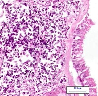 Small Cell Lung Cancer (SCLC): Practice Essentials, Pathophysiology, Etiology