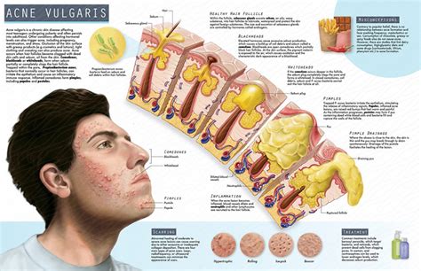 Pathology of Acne Vulgaris | AMI 2018 Meeting