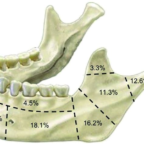 Orif Mandibular Fracture