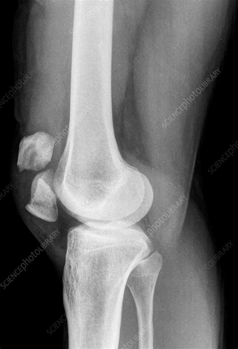 Broken knee cap, X-ray - Stock Image - F036/0215 - Science Photo Library