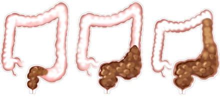 Encopresis in Children | Causes, Diagnosis & Treatment