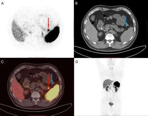 Frontiers | Laparoscopic treatment for an intrapancreatic accessory ...