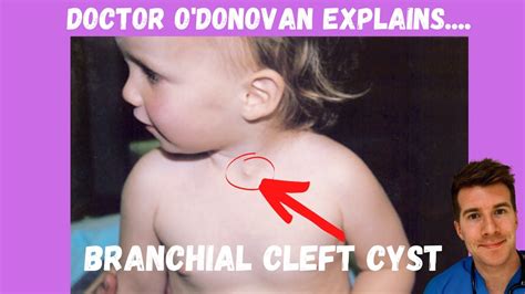 Explaining Branchial Cleft Cyst | With Dr O'Donovan - YouTube