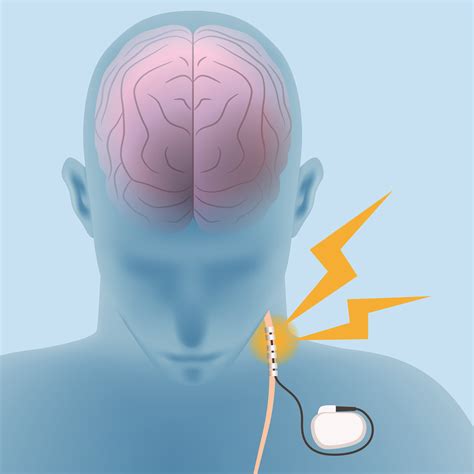 Vagus nerve stimulation - NeuRA Library