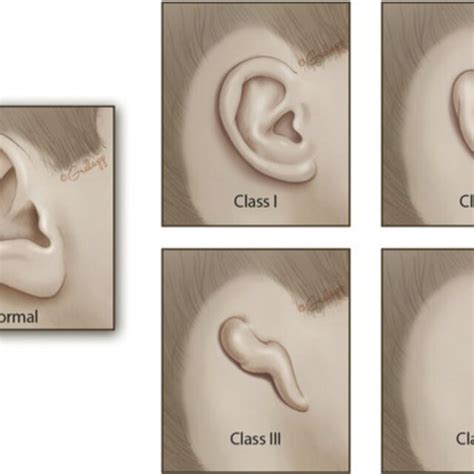 Classification of Microtia Severity. | Download Scientific Diagram